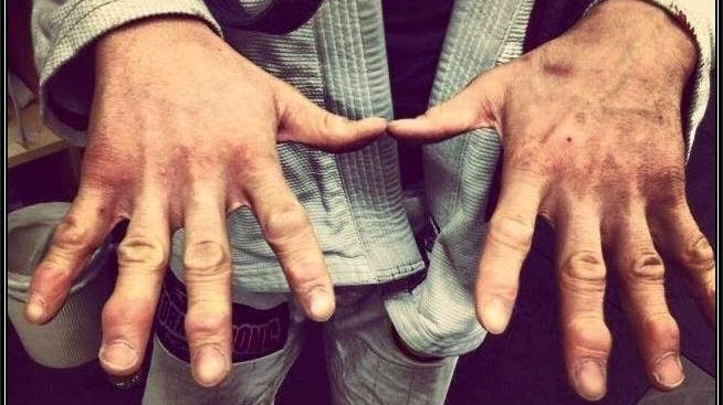 The "Finger-Saver" Brabo Choke