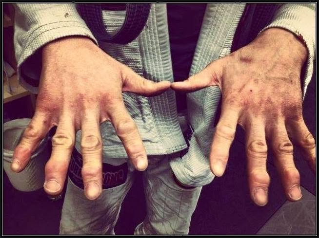 The "Finger-Saver" Brabo Choke